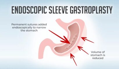 Endoskopik tüp mide başarısızlığı, revizyon cerrahisi ve yeniden kilo alımı nedenleri – Prof. Dr. Halil Coşkun