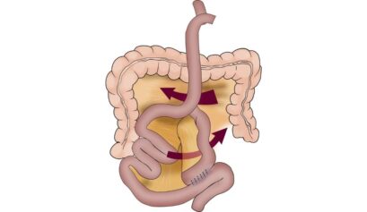 Gastrik bypass sonrası internal herniasyonun anatomik yerleşimini ve mezenterik defektleri gösteren şematik görsel